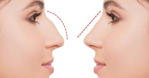 Estetikli burun nasıl anlaşılır?