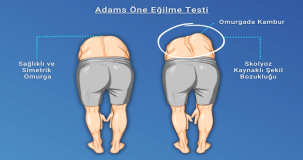 Evde skolyoz testi nasıl yapılır?